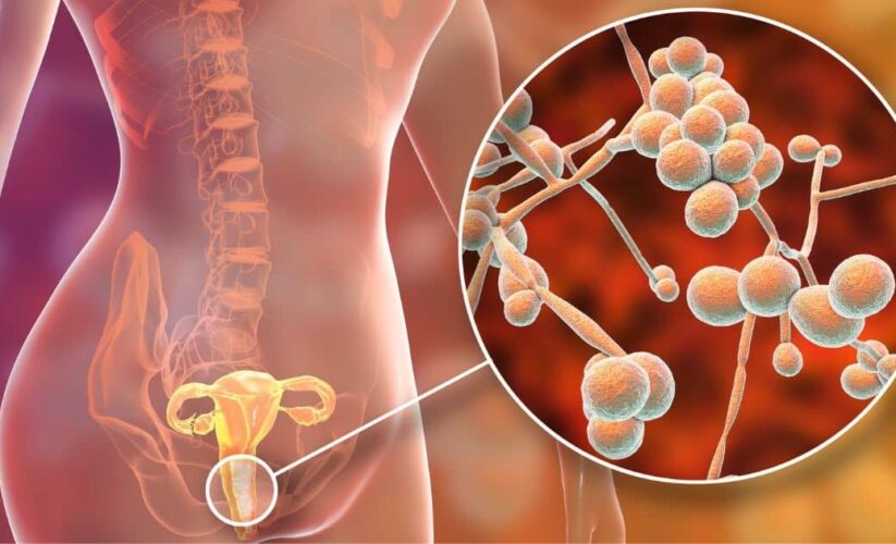 Candida Overgrowth from a Functional Medicine Perspective