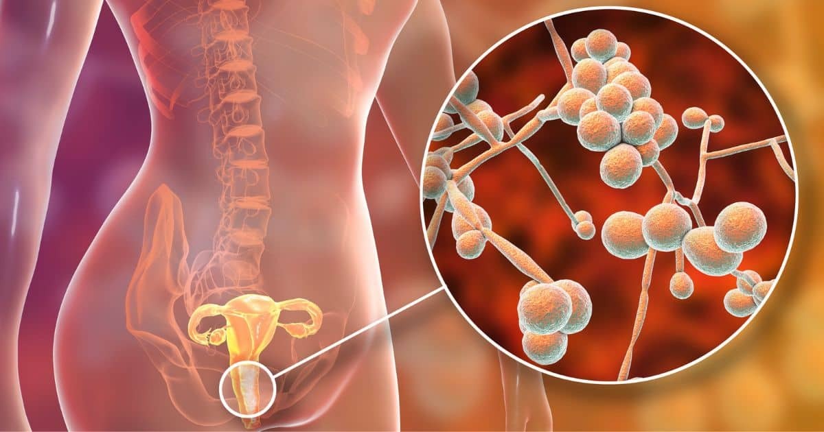 Candida Overgrowth from a Functional Medicine Perspective